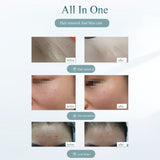 Laser Hair Removal Device - Painless Hair Removal Tool